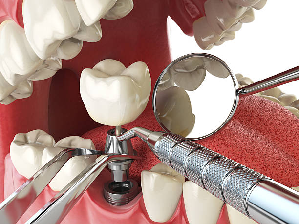 Best Emergency Dentist for Lost Fillings or Crowns in Nyon Lake, CA