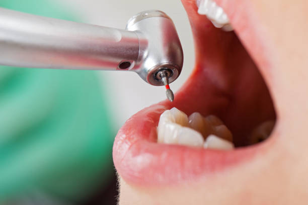 Best Emergency Dental Extractions in Nyon Lake, CA